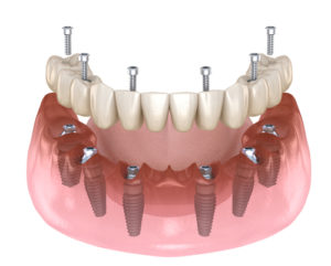 Implant Prosthesis